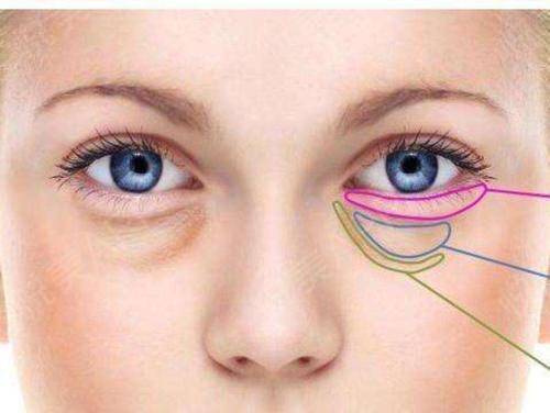 外切眼袋的過程是什么樣子的？