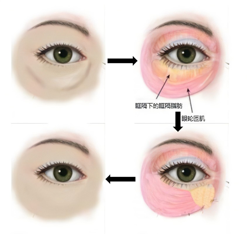 消除眼袋的方法有哪些？