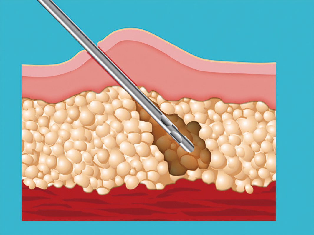 胸太大可以抽脂嗎多少錢？