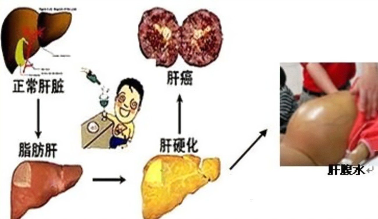 查出肝硬化還有救嗎？