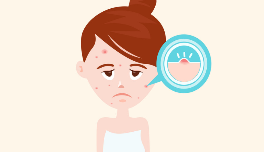 青春痘有救了嗎？聽說青春痘也有疫苗了？