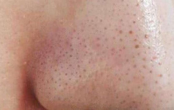 清潔面膜哪個(gè)牌子可以快速祛黑頭？趙薇、薇婭 推薦的紐西之謎泥膜真的好用嗎？